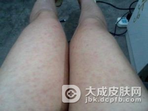 过敏性紫癜患者需要做哪些检查
