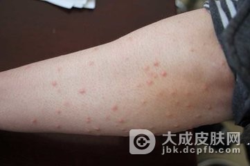 黄瘤病的鉴别的特征