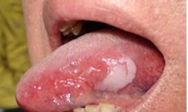 哪些疾病会引起外阴粘膜白斑的发生
