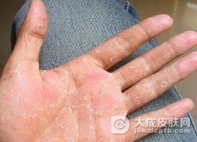 水疱型手癣是什么样的疾病