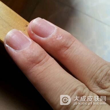 手癣是否会传染呢