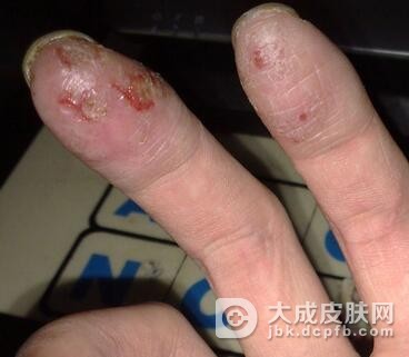 手癣的症状什么样的呢
