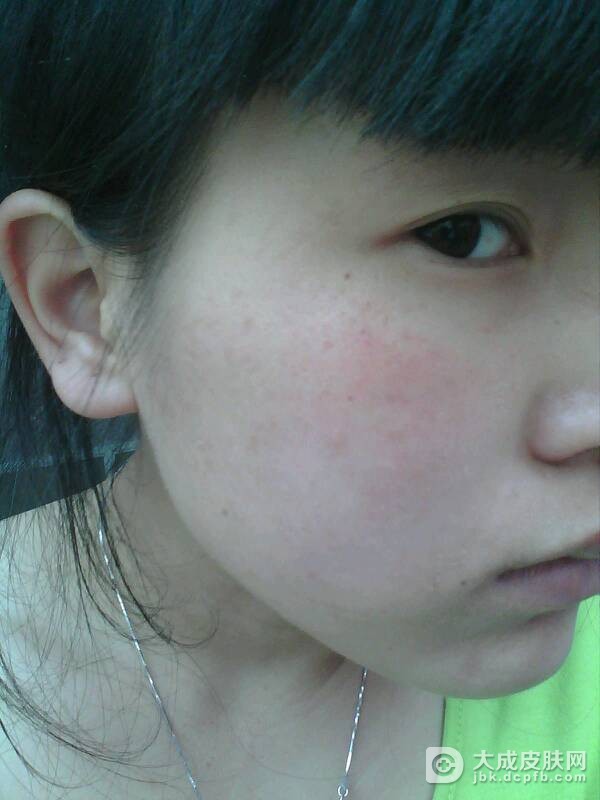 避免皮肤过敏要养成良好的习惯