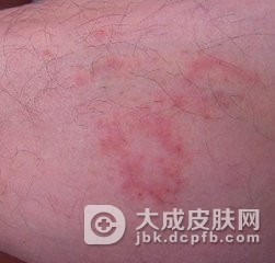 怎么处理传染性湿疹样皮炎