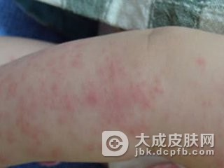 传染性湿疹样皮炎的皮损特征都有啥