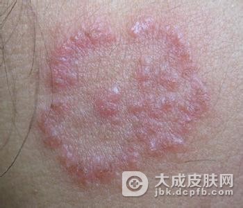 神经性皮炎的护理要点有哪些