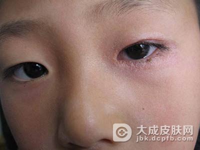 异位性皮炎预防方法有哪些