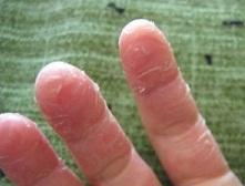 专家推荐6种预防手足皲裂的方法