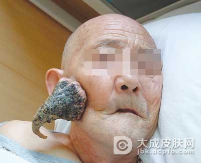 角化棘皮瘤怎么诊断