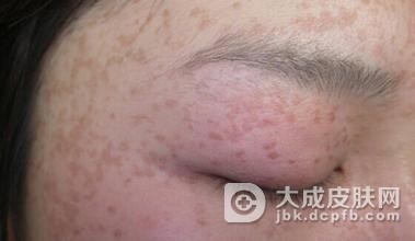 脸上青春痘怎么护理