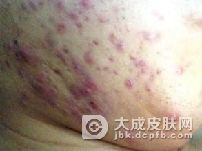 青春痘的主要分类有哪几种