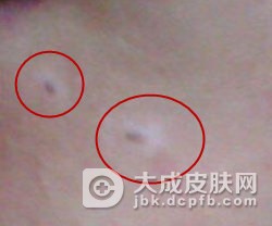 晕痣病发后的症状体征是什么？