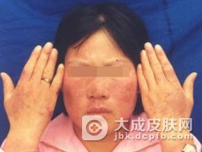 传染性红斑可以预防吗
