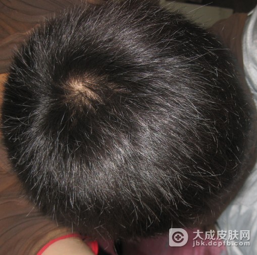 如何治疗脂溢性脱发呢？