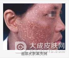 黑变病的针对性治疗