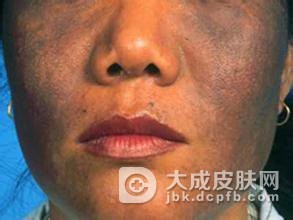 黑变病都有哪些的病因