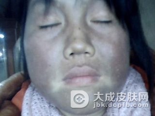 皮肤黑变病的精神因素的分析