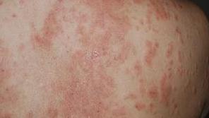 传染性湿疹样皮炎的患者应要注意什么