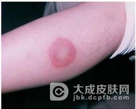 红斑狼疮发病后有什么症状