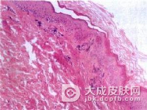 肠病性肢端皮炎护理的措施