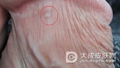 淋病要怎么有效预防