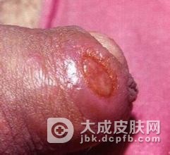 患有慢性淋病的临床表现