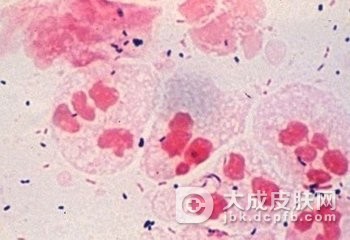 常见的一些非淋菌性尿道炎的治疗方法
