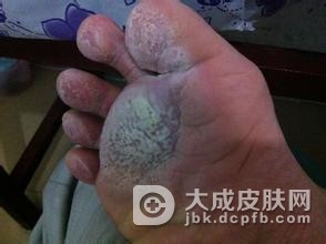 遵循医嘱合理治疗脚气