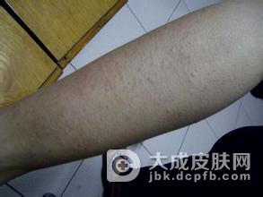 荨麻疹会有后遗症吗