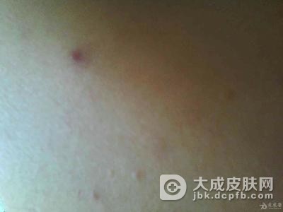 患有毛囊炎的症状是怎么样的