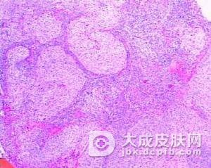 外阴鳞状性癌是怎么形成的呢