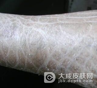 鱼鳞病如何饮食比较健康呢