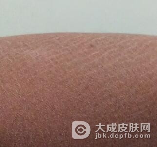 得了鱼鳞病该怎么治疗好