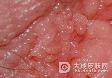 女性尖锐湿疣发病后的症状有哪些