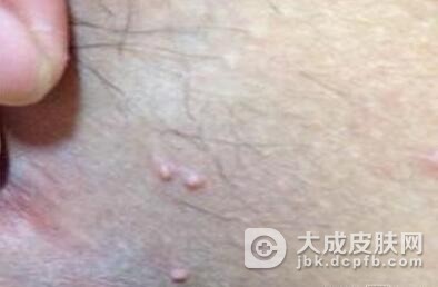 女性尖锐湿疣易发部位有哪些呢