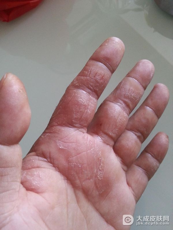 手部湿疹应该注意什么