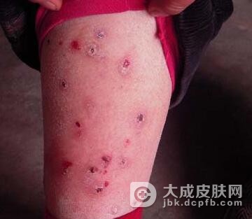 需要如何护理头部牛皮癣疾病