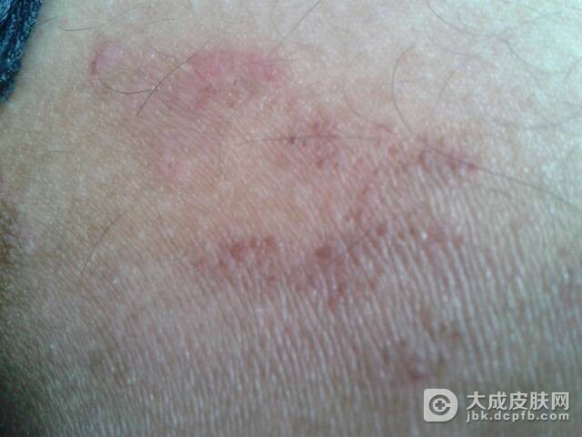 春天需注意预防接触性皮炎