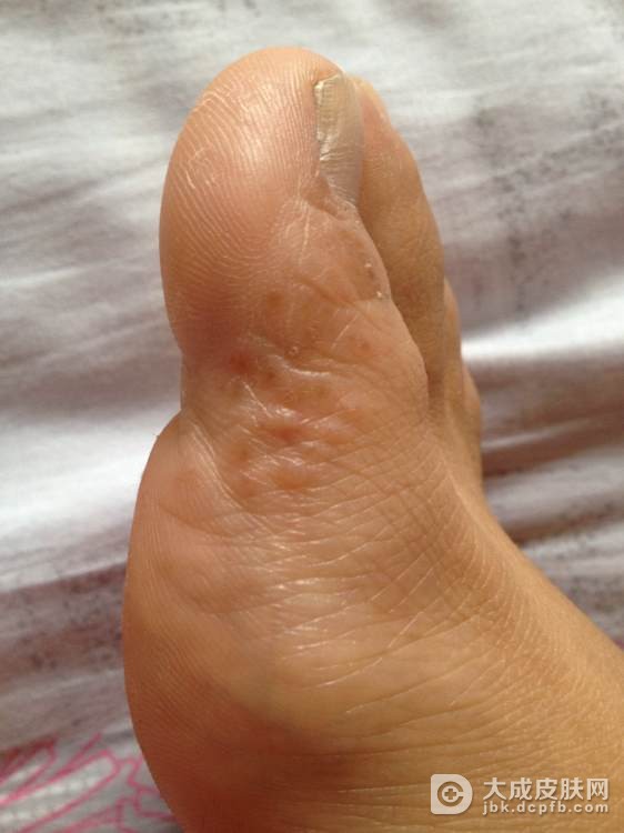 冬季正确护理可治疗脚气