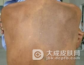 黑变病的发病原因都有哪些