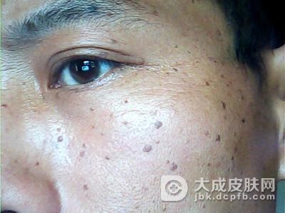 预防遗传性雀斑有哪些注意事项