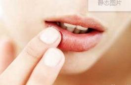 白色念珠菌也会引起口腔粘膜白斑