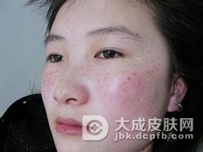 长雀斑的危害有哪些