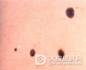 外阴软纤维瘤能治吗