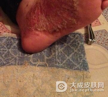 新生儿出现脓包疮有哪些症状特点