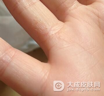 患上了手癣可以做家务吗