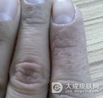 生活中手癣患者要注意什么