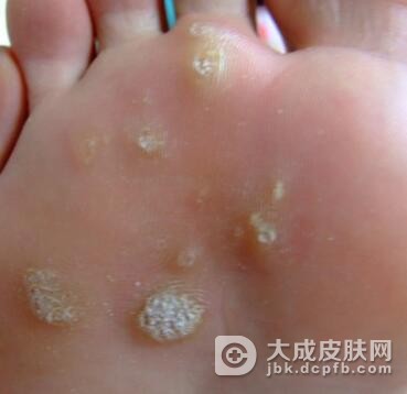 跖疣最好的治疗方法是什么呢