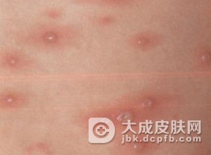 水痘的并发症