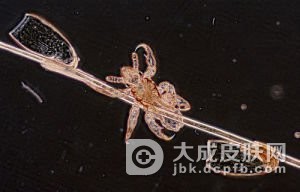 阴虱复发的原因可能有哪些